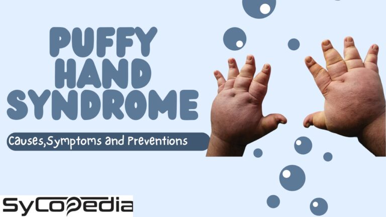 Puffy Hand Syndrome